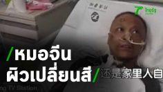 ตะลึง! หมอจีนป่วย โควิด-19 ผิวหนังเปลี่ยนสี | Thairath Online