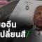 ตะลึง! หมอจีนป่วย โควิด-19 ผิวหนังเปลี่ยนสี | Thairath Online